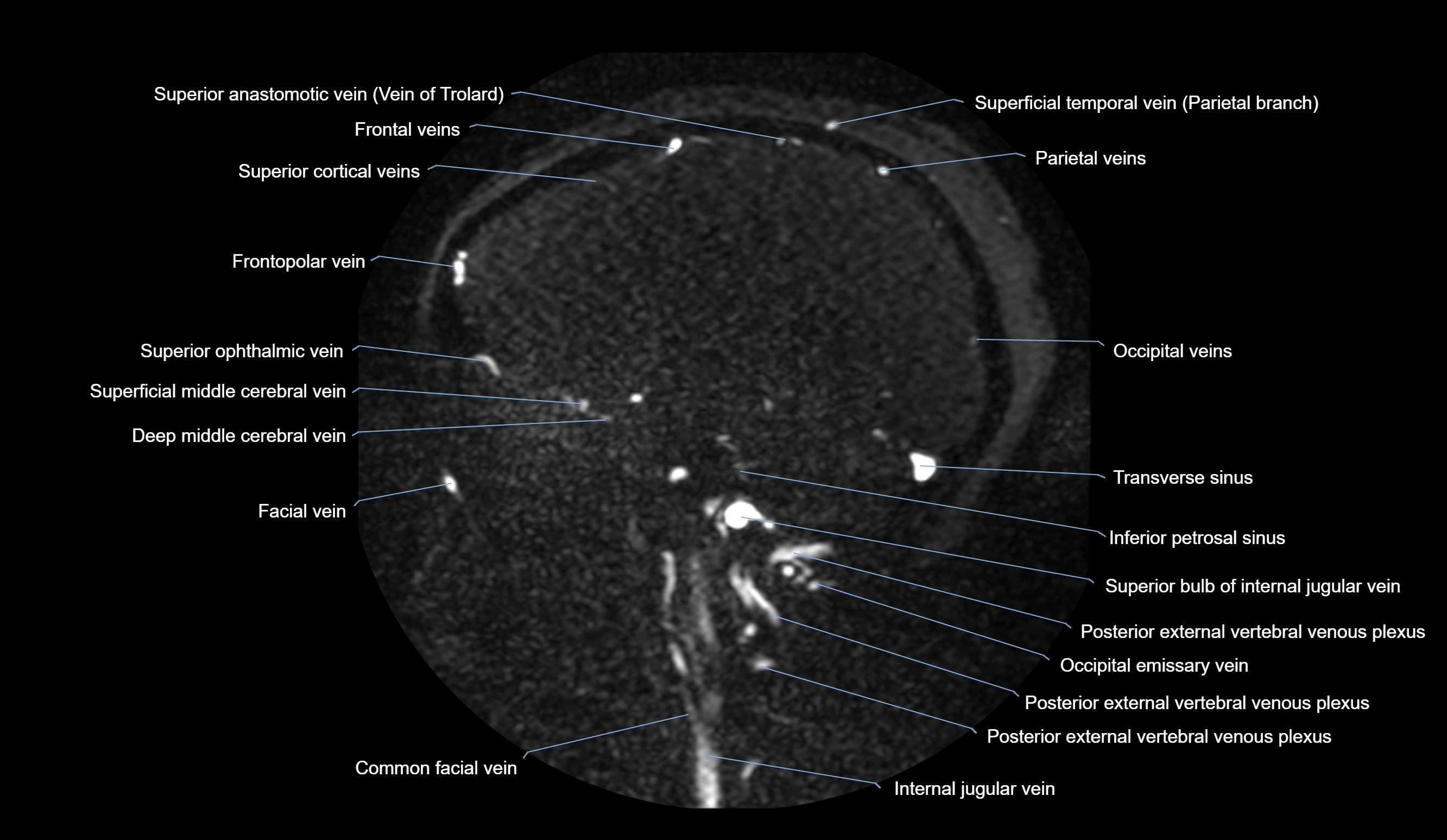 MRV brain sagittal anatomy 3T MRI labelledimages -00031.webp